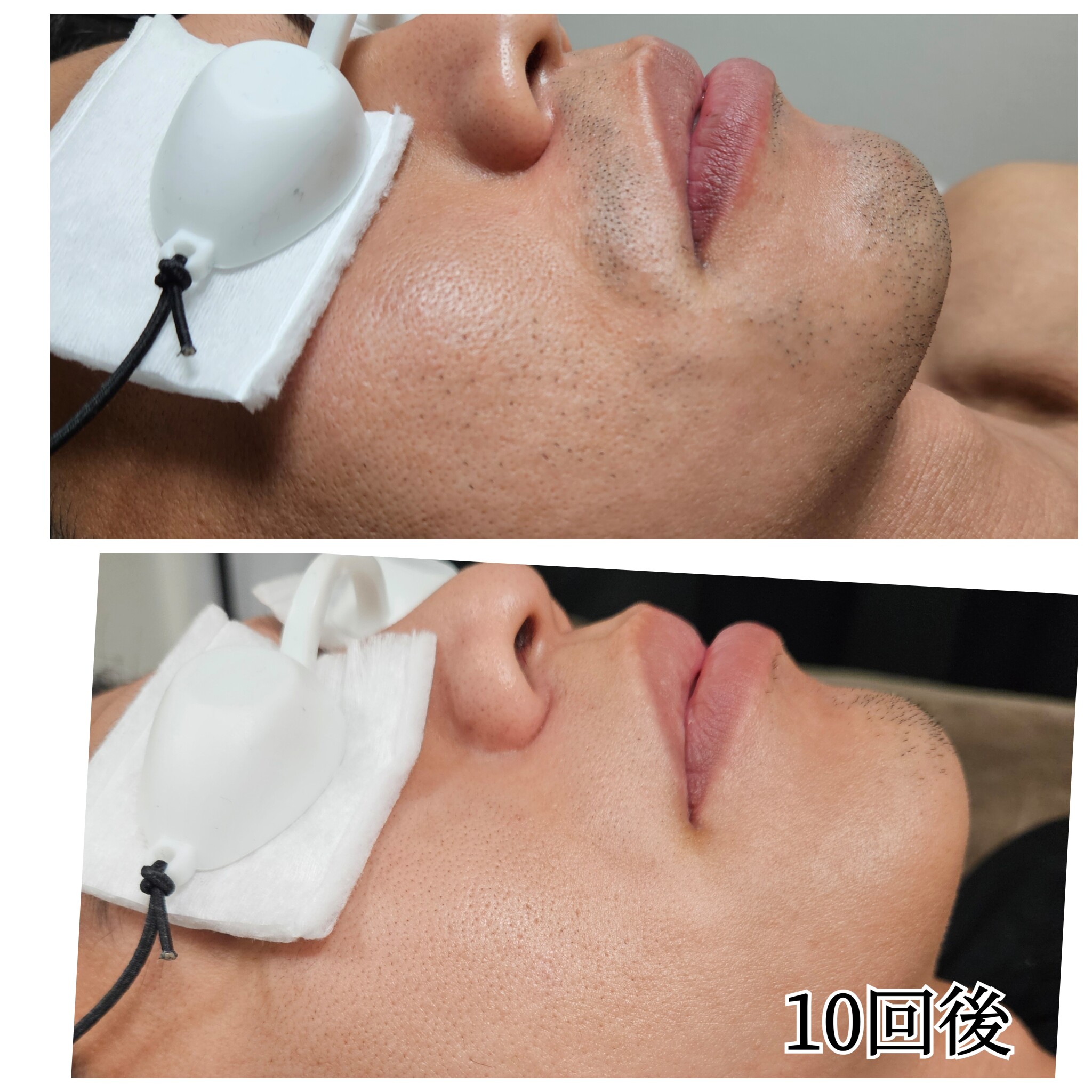 ヒゲ脱毛 Before/After