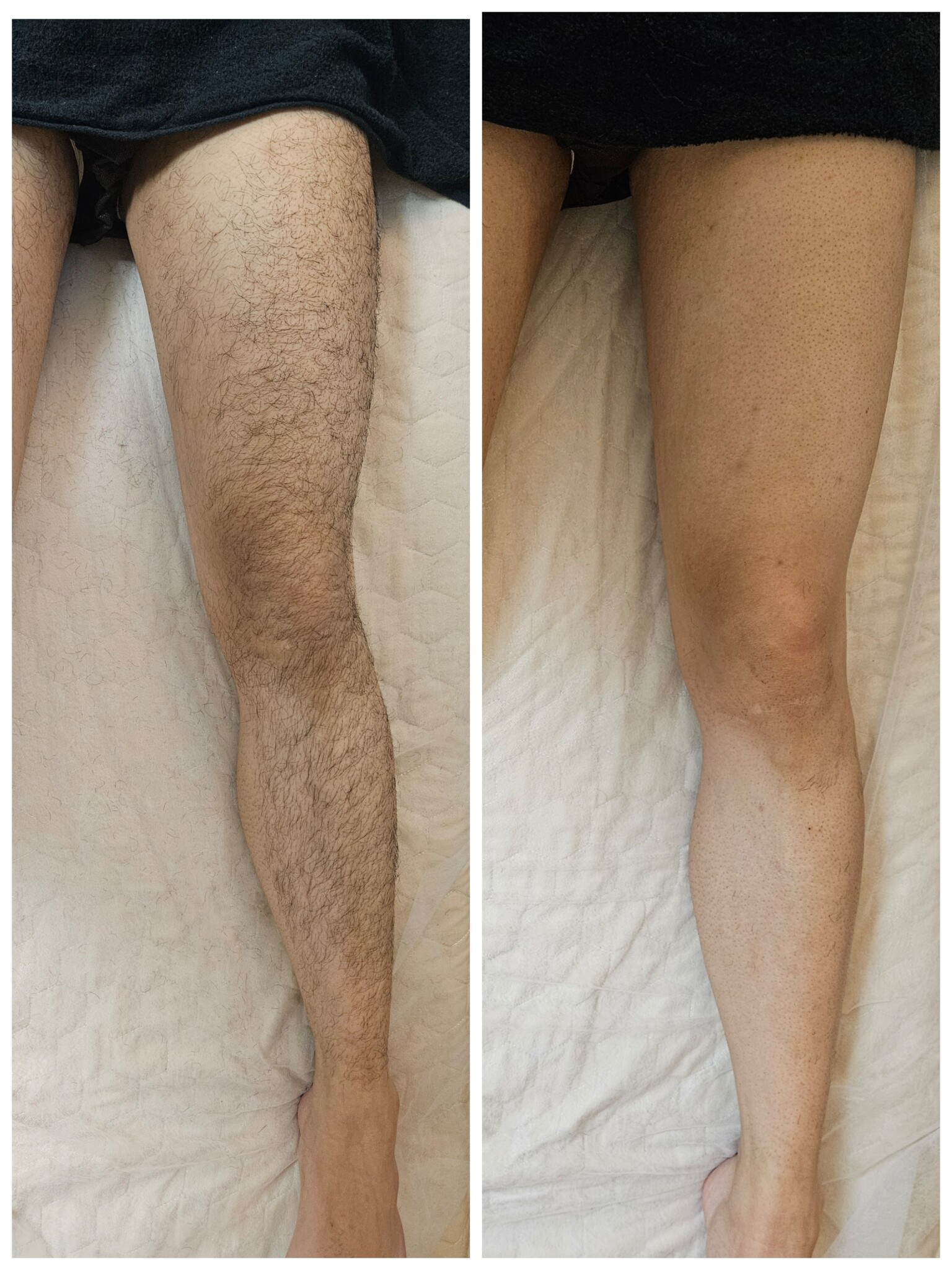 脚脱毛 Before/After